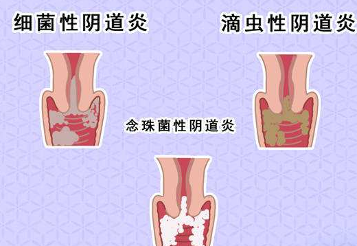 阴道分泌物91短视频免费下载剖析什么是细菌性阴道炎