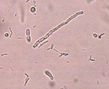 白带常规91短视频免费下载厂家分析白带常规检查白细胞的意义