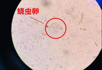 阴道分泌物91短视频免费下载警惕外阴绕虫病易在儿童身上出现